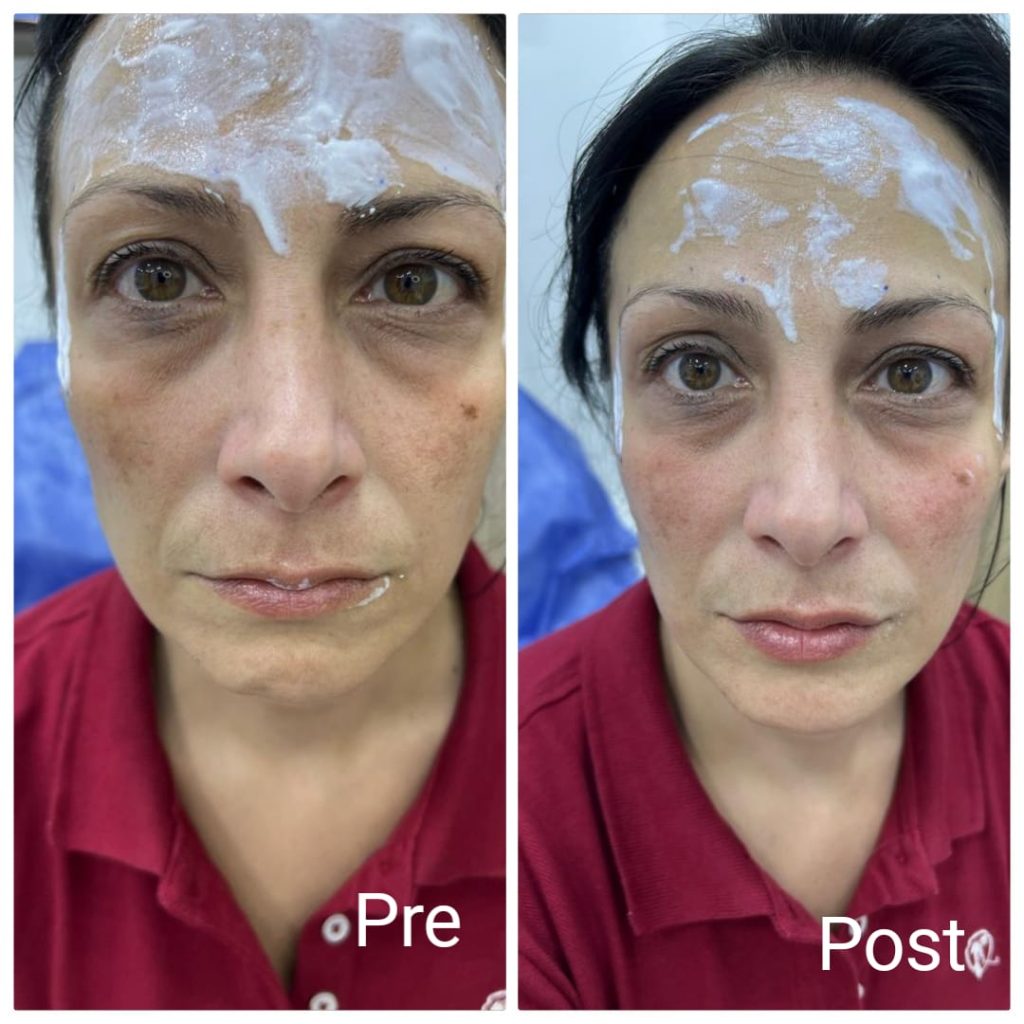 Facial filler injection